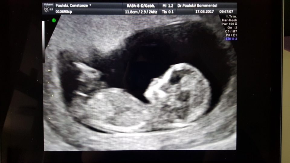 Schwarzweiße Ultraschallaufnahme eines Embryos im Mutterleib. Schwarzweiße Ultraschallaufnahme eines Embryos im Mutterleib.