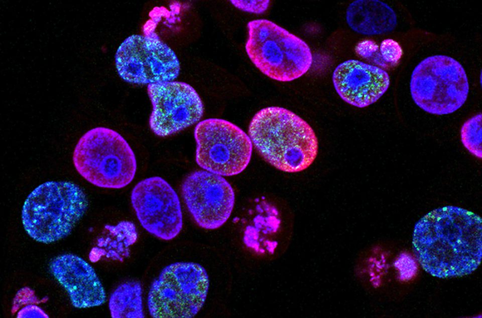 Mikroskopische Aufnahme von in Blau und Rosa eingefärbten Darmkrebszellen, in denen sich die Zellkerne farblich abheben.