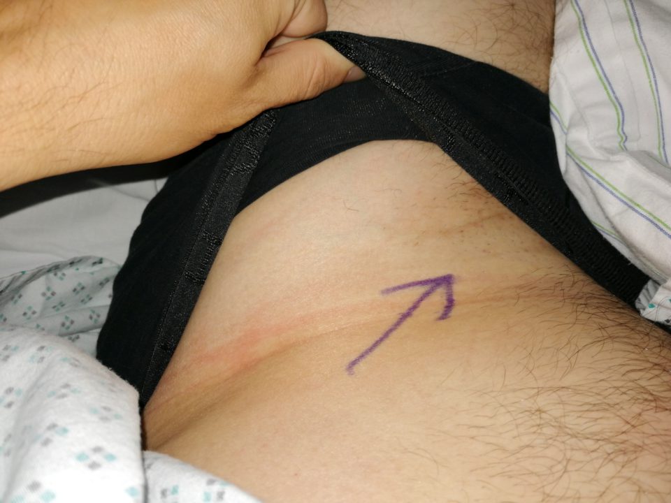 Filzstift-Markierung auf der Haut eines Patienten in der Lendenregion vor der Hodenoperation.